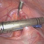 1 surgery Laparoscopic Combo Surgical 19